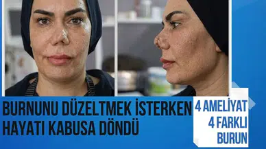 Burnunu düzeltmek isterken hayatı kabusa döndü: 4 ameliyat, 4 farklı burun