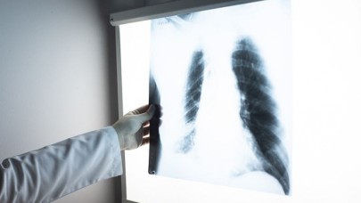 Göğüs röntgeninden hastalık teşhisi yapay zekayla hızlanacak