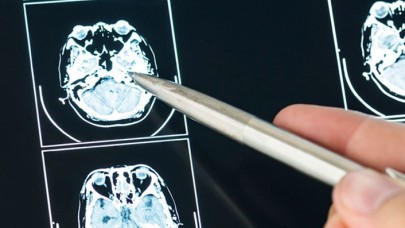 MS hastalığı,  kadınlarda 2 kat fazla görülüyor