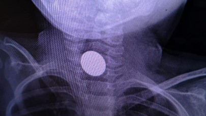 3 yaşındaki çocuğun boğazına madeni para takıldı