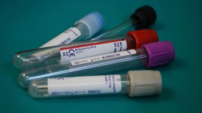 Hepatit virüsüne sahip her 10 kişiden 9'u hastalığından habersiz