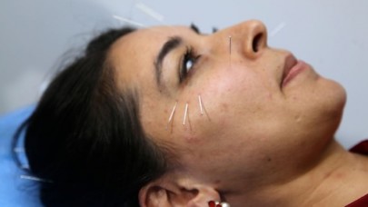 Kozmetik akupunktur ile en az 5 yaş daha genç görünmek mümkün