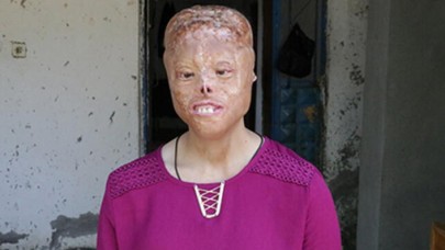 Yüz ve kafa derisi yanan Leyla yeni bir yüz bekliyor