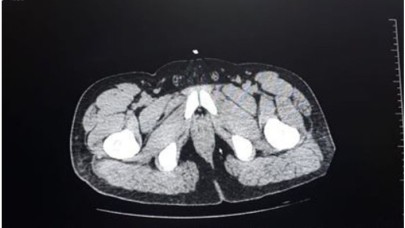 Karnından 22 poşet eroin çıktı