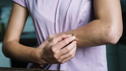 İstanbul İl Sağlık Müdürü'nden 'Uyuz' Açıklaması: Geçen Seneye Göre Artış...