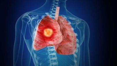 Akciğer Kanserinin Tedavisi Artık Mümkün: Kemoterapi Yerine İnoterapi