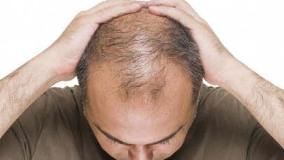 Kellik ile baş edebilmek için: Saç ekimi