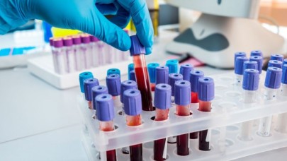 A kan grubundakiler dikkat: Koronavirüse yakalanma riskiniz daha fazla!