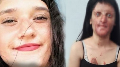 Erkek arkadaşının asitli saldırısına uğrayan Berfin Özek ilk kez konuştu!