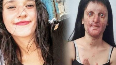 Yüzüne asit atılan Berfin Özek davasında flaş gelişme: Avukatı davadan çekildi!