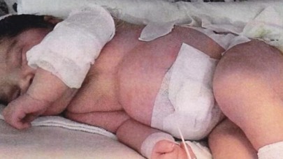 Doğumhanede ısıtıcıyla yandı,  18 gün komada kaldı!