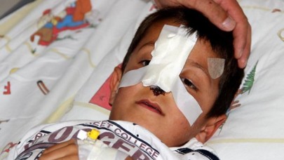 Başıboş dolaşan sokak köpeği küçük çocuğun burnunu kopardı!