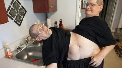 Dünyanın en uzun hayatta kalan yapışık ikizleri 68 yaşında öldü