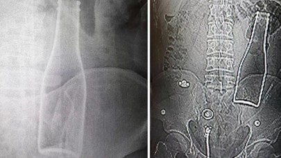 Kalın bağırsağından şişe çıkan genç: Yanlışlıkla oldu