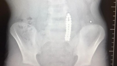 Karın ağrısıyla hastaneye giden çocuğun midesinden çıkanlar doktoru şoke etti!