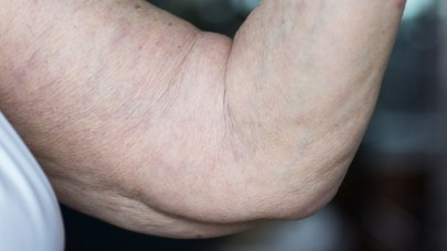 Lipödem’e dikkat: Kadınlarda sık görülüyor!