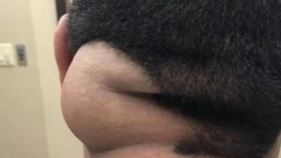 17 yıl boyunca kafasında hayvanla yaşadı