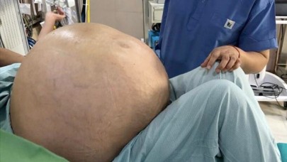 52 yaşındaki kadının karnından 54 kilo tümör çıkarıldı