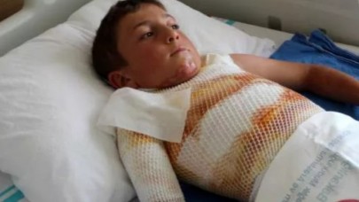 Ardahan'da 10 yaşındaki çocuk gömleğindeki ipi yakmak isterken kendini yaktı