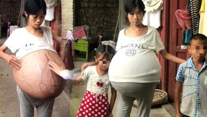 Karnında 20 kiloluk kütle taşıyan genç kadın tıp dünyasını şaşırttı