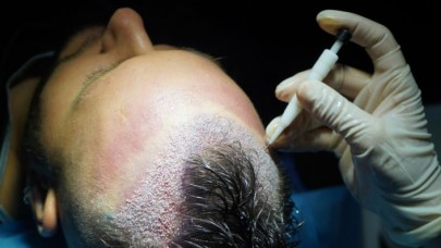 En İyi Saç Ekim Merkezleri Nelere Dikkat Ediyor?