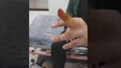 Hasta yakını,  tartıştığı güvenlik görevlisinin parmağını ısırıp kopardı