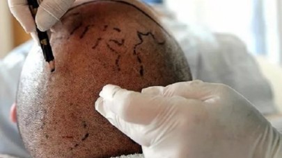 Saç ekiminin ardından rahatsızlanan hasta hayatını kaybetti