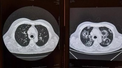 Koronavirüs tespitinde yeni yöntem geliştirildi