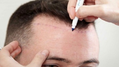 Saç Ekimi Merkezleri