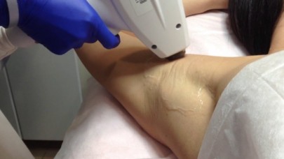 Buz Lazer Fiyatları