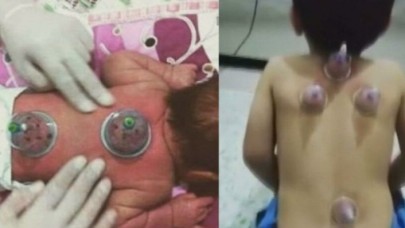Küçük çocuğa hacamat yapılan anlar sosyal medyada tepki topladı: Uzmanlardan açıklama!