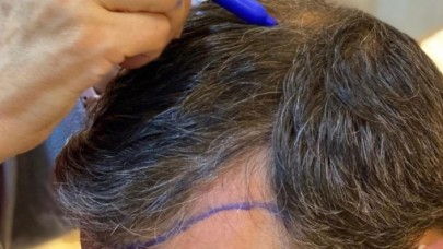 Saç Ekimi Aşamaları Nelerdir,  Neopital Anlatıyor!