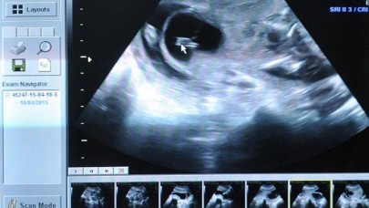 Ultrasonda bebeğinin yüzünde kaybettiği büyükbabasının yüzünü gören hamile kadın,  şoke oldu