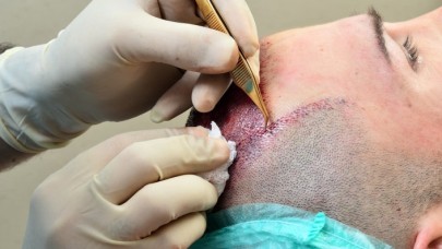 Saç Ekim Kliniği Nasıl Seçilir? Seç Ekim Fiyatları Nasıl Olmalı?