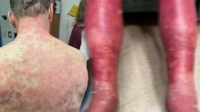 Tek dozluk korona aşısında 'yan etki' kabusu! Bu hale geldi