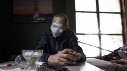 Burnunda çıkan siğil hayatını kararttı: Yüzünü kaybetti