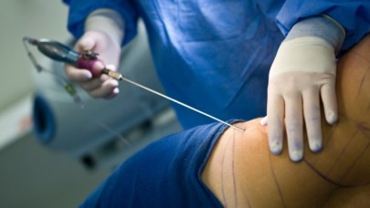 Op. Dr. Hüseyin Kandulu Liposuction Nedir?