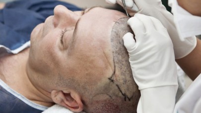 Saç Ekimi Yaptırırken Nelere Dikkat Edilmelidir?