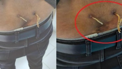 ‘Alternatif tıp’ adı altında yapılan işkencede son nokta: Çamaşır ipiyle bel tedavisi!