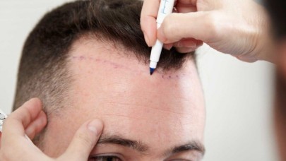 Retouch Body Clinic Saçlar Ektirme İle Doğal Görünüm