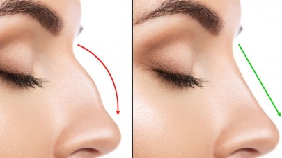 Op. Dr. Deniz Küçükkaya - Burun Estetik Yöntemleri