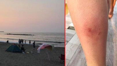 Sahil kapatılmıştı: Denize girenlerde görülen kaşıntının nedeni belli oldu