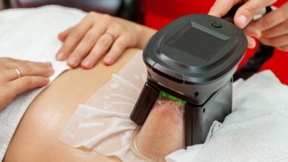 Soğuk Lipoliz Nedir?