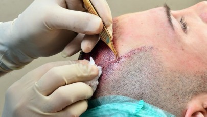 Saç Ekim'i Yapan Kliniklerin Özellikleri Nasıl Olmalıdır? Smile Hair Clinic