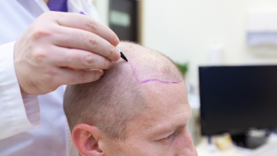 Saç Ekimi Öncesinde Dikkat Etmeniz Gerekenler