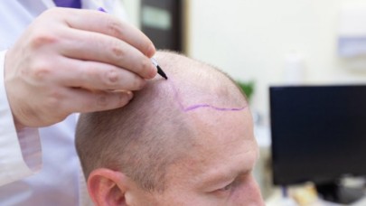 Diyanet'ten 'saç ektirme' ve 'peruk' fetvası