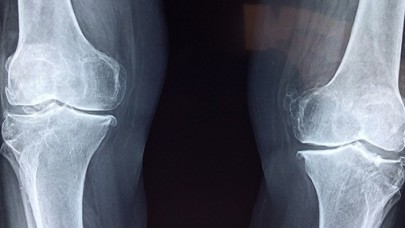 Eklem iltihabında erken tanı,  sakatlık ve iş gücü kaybını önlüyor