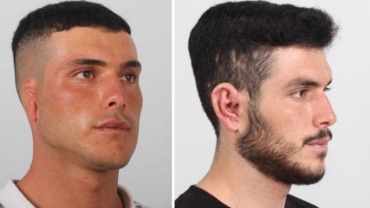 Göğüs kafesinden alınan kıkırdakla kulak kepçesi