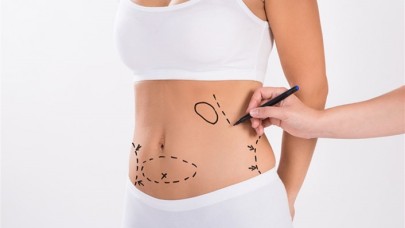 Liposuction Hakkında Bilinmesi Gerekenler
