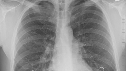 Türkiye'de yılda 35 bin kişi akciğer kanseri tanısı alıyor